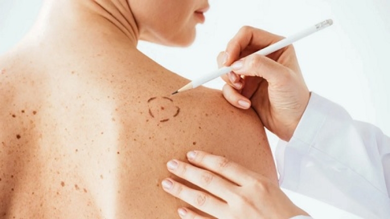 Lanzaron una Campaña de Prevención del Cáncer de Piel