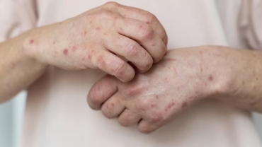 Activan una alerta epidemiológica por sarampión en la Argentina